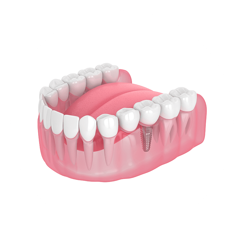 replacing-a-single-tooth-160x160-1