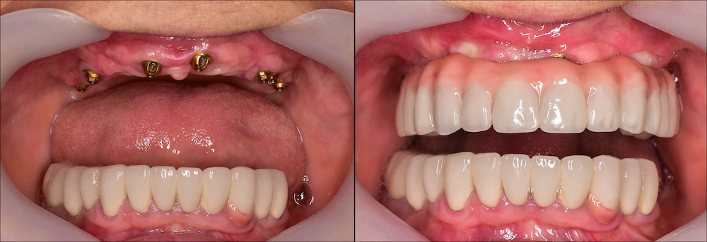 full mought reconstracting by implants and crowns full mought reconstracting by implants and crowns
