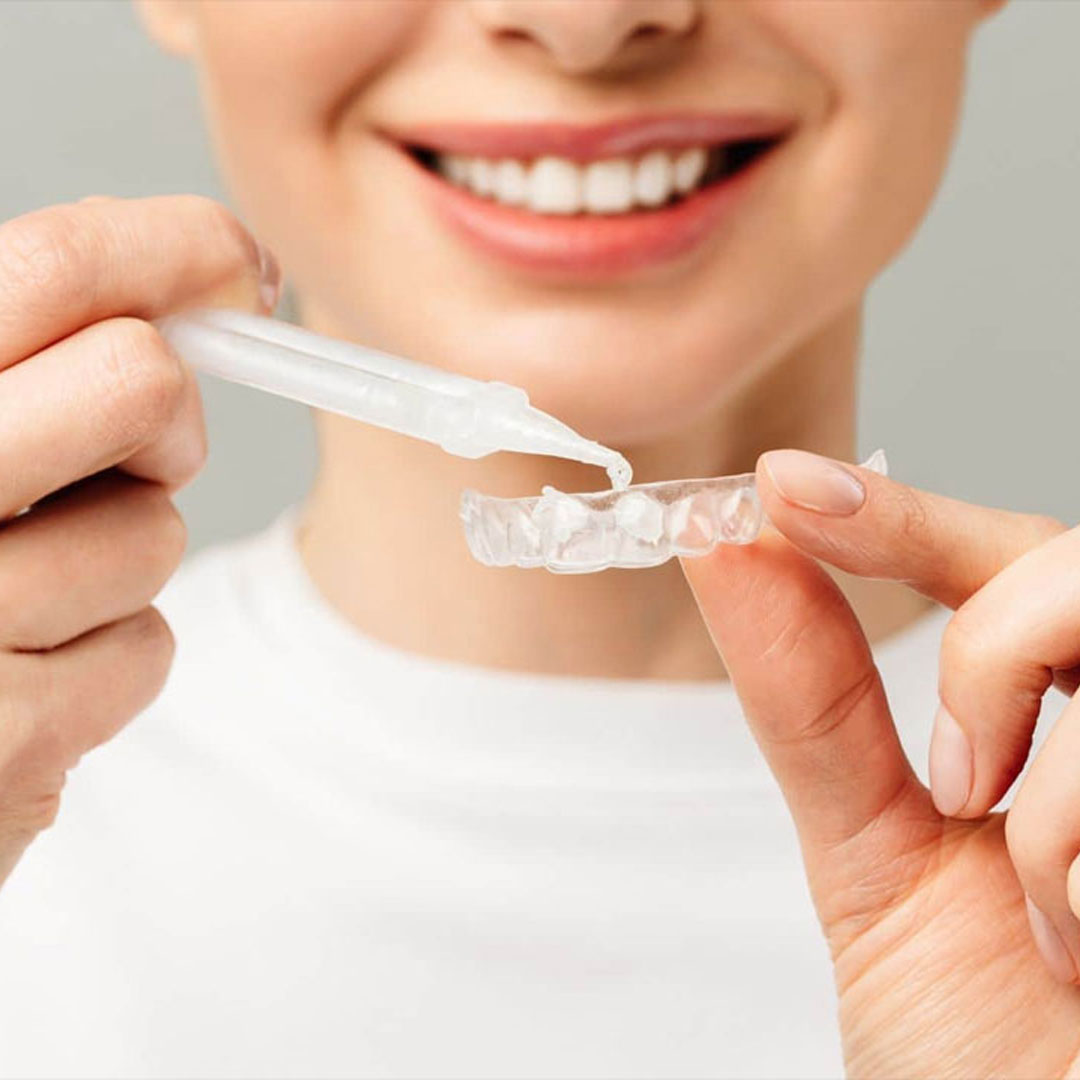 Teeth Whitening treatment Shepperton